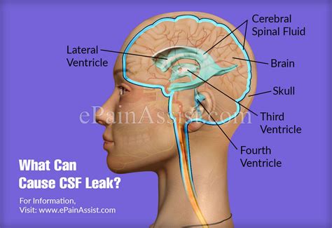 long-term side effects of csf leak|Cerebrospinal Fluid Leak: When Are Symptoms。